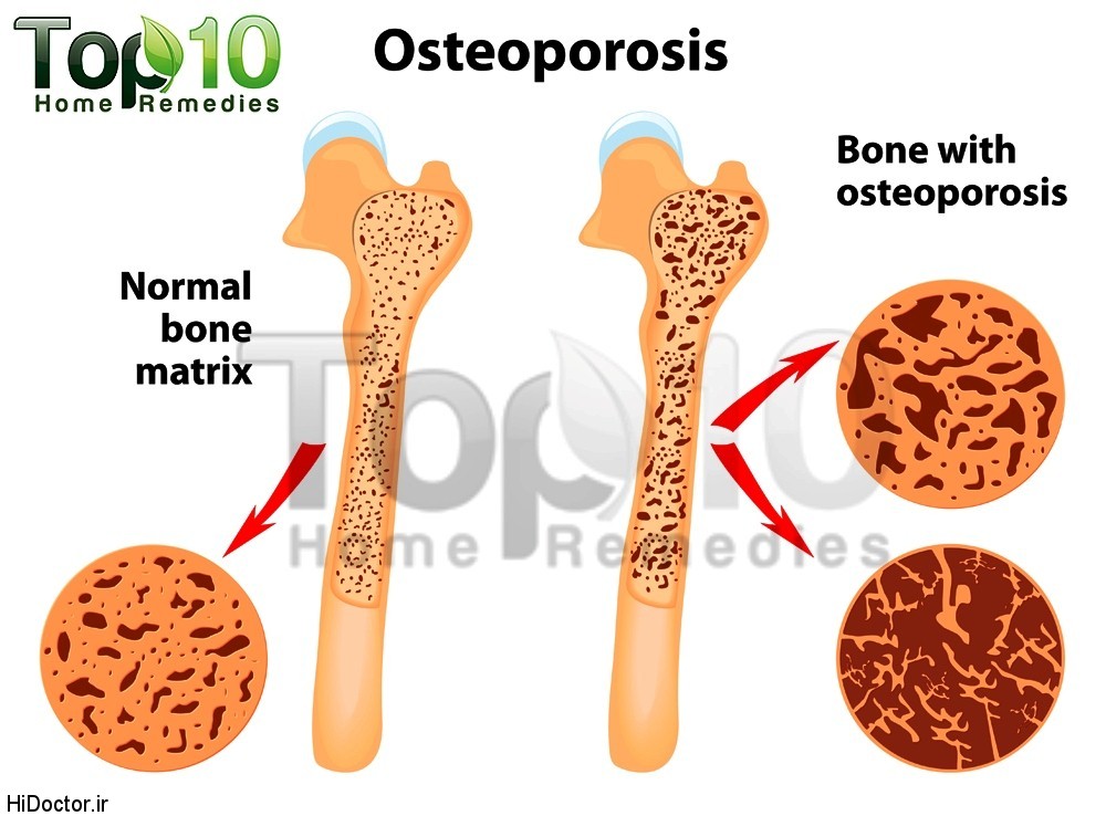1487580083osteoporosis-illustration-opt.jpg